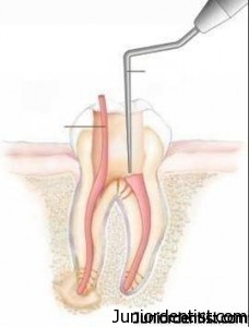 root canal treatment in restorative dentistry