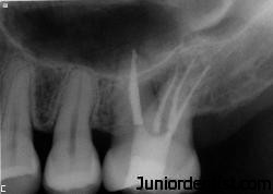 Root canal treatment restoration