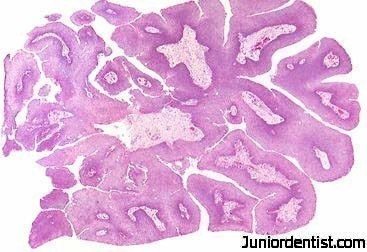 squamous papilloma skin pathology