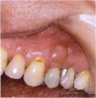 Gingival cyst of the adult