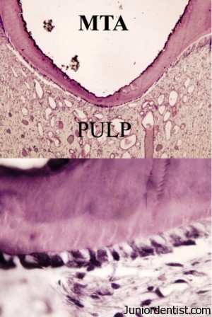 Direct pulp capping - Dentin bridge formation
