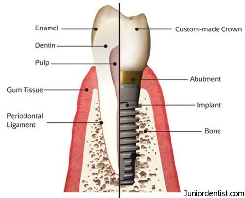 What is a dental implants