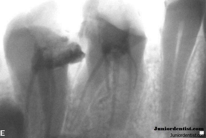 Maxillary Molar with 6 root canals