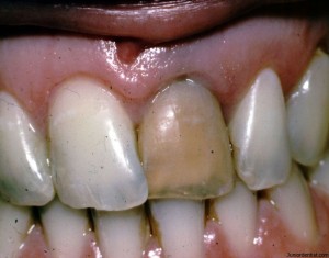 Discoloration of tooth due to Trauma