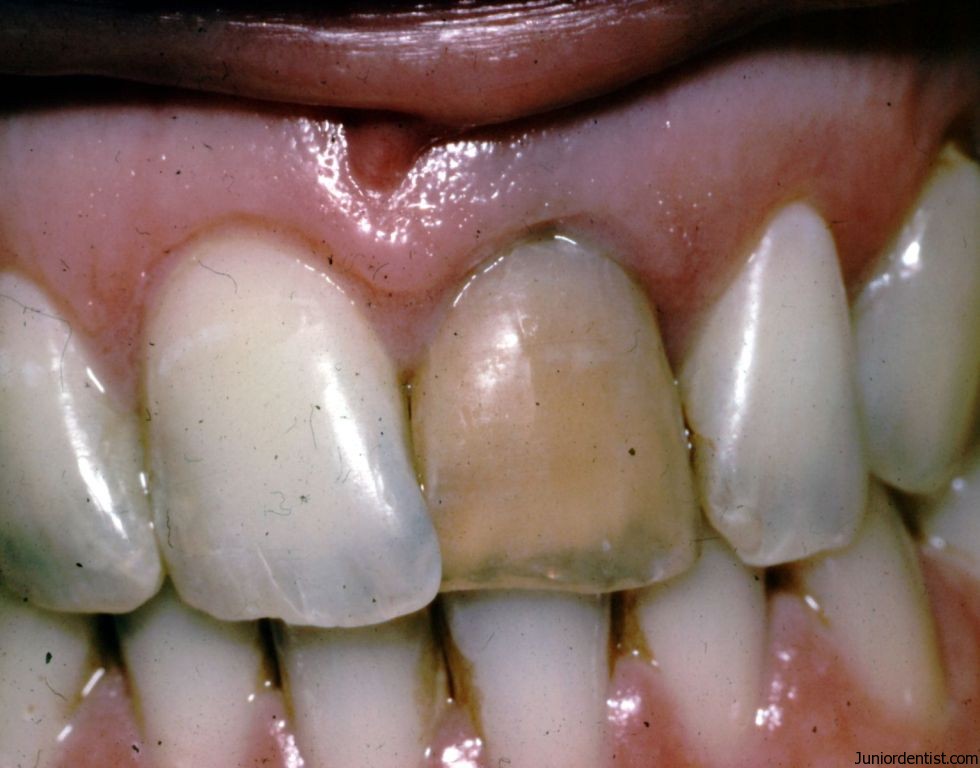 causes dark yellow teeth