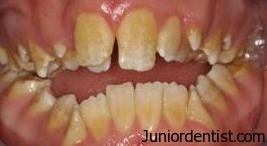 Tooth Discoloration due to fluorosis stains
