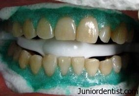 Teeth Whitening - bleaching procedure