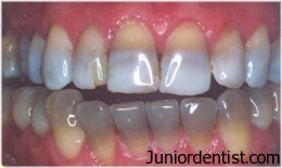 Tetracycline Stains - tooth discoloration