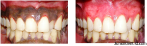 de pigmentation of gums - Cosmetic dentistry