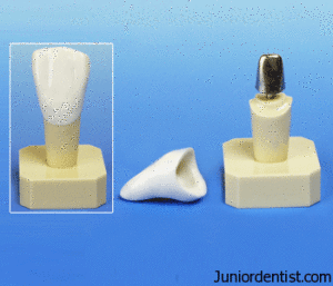 post and core in endodontics