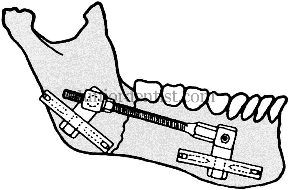 Immobilization in various types of Fracture of mandible