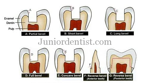 Types of Bevels and their uses in tooth or cavity preperation