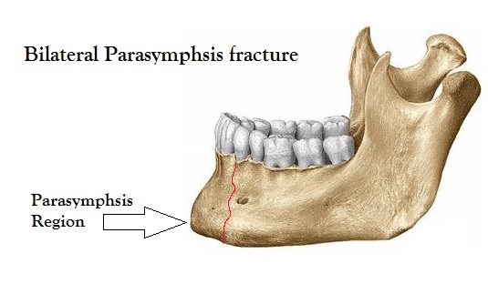 Bilateral Parasymphysis fracture