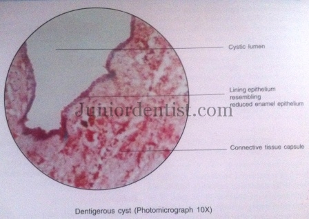 Microscopic Features of Dentigerous Cyst