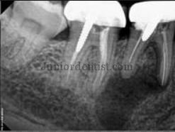 Root Canal Treatment failures