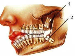 3rd molar impaction causes - lack of space