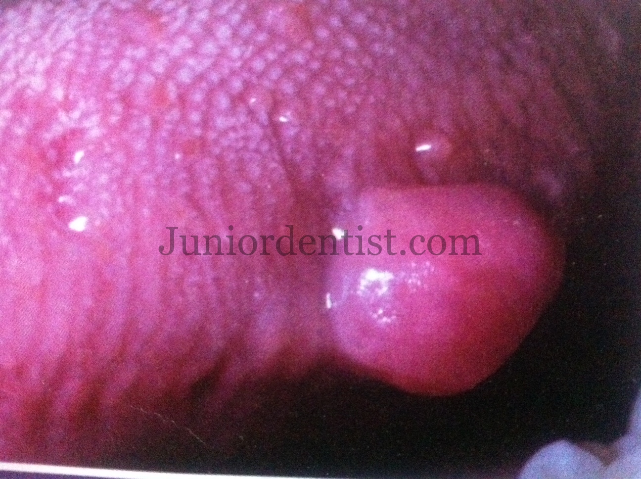 Images in…: Traumatic fibroma of tongue - ncbi.nlm.nih.gov