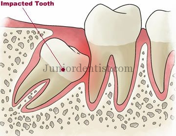 Local Examination for Diagnosis of Impacted 3rd molar