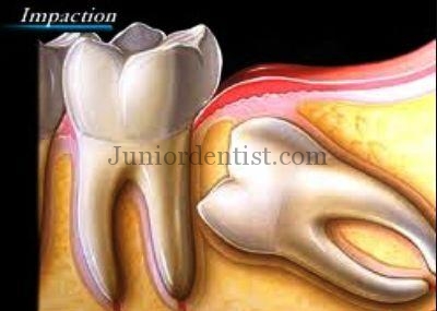 why should you remove 3rd molar if impacted