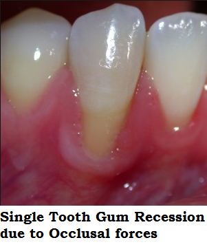 Single tooth gingival recession