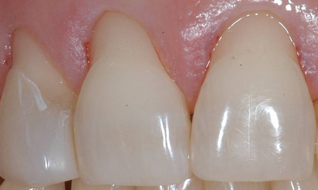 how to stop receding gums and gingival recession