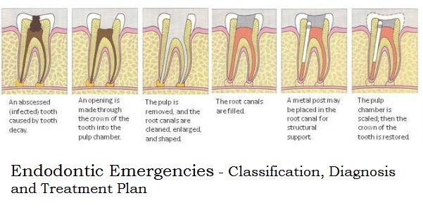 Endodontic Emergencies classification and diagnosis