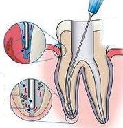 sodium hypochlorite use in root canal treatment