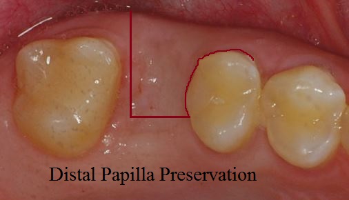 Distal papilla preservation flap for dental implants