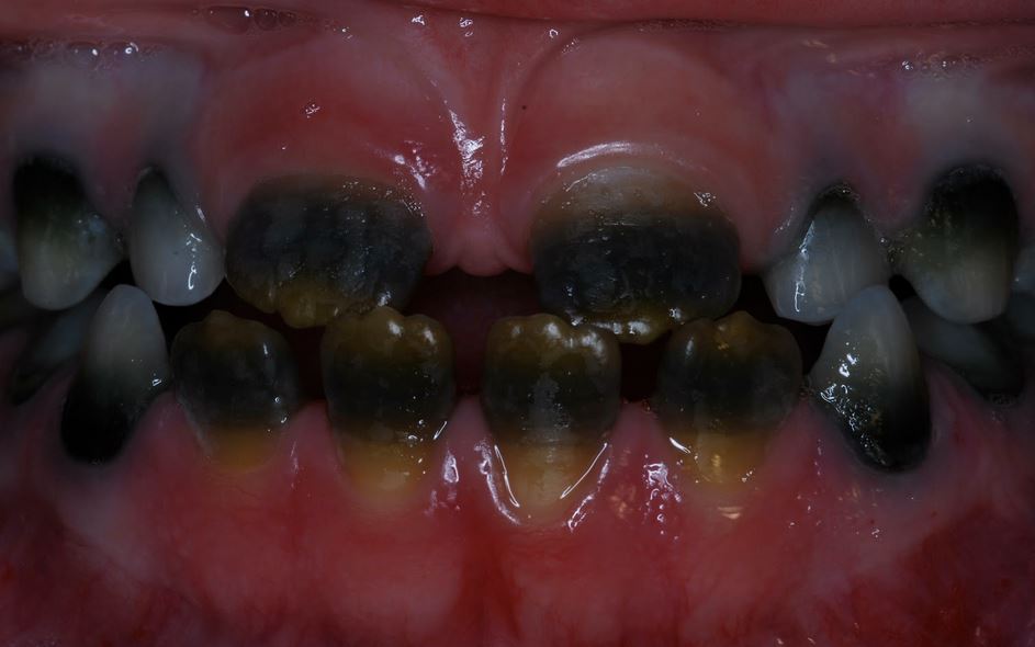 Discoloration of color of teeth - developmental disturbances