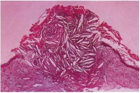 Radicular Cysts Histologic features