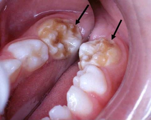 Molar Incisor Hypomineralization clinical features etiology and treatment