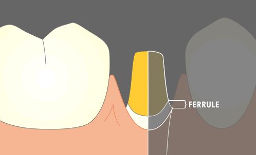what is ferrule effect and types of ferrules in dentistry