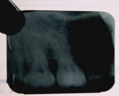 Dental Radiographic faults and artifacts