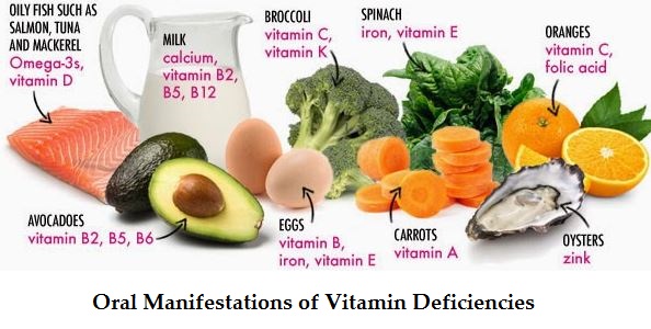 Oral manifestations of Vitamin deficiencies