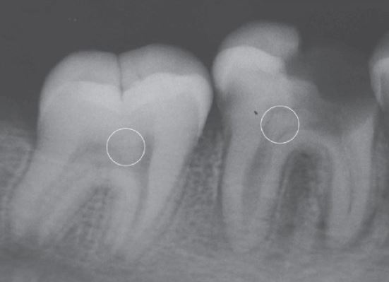Pulp Stones radiographic appearance