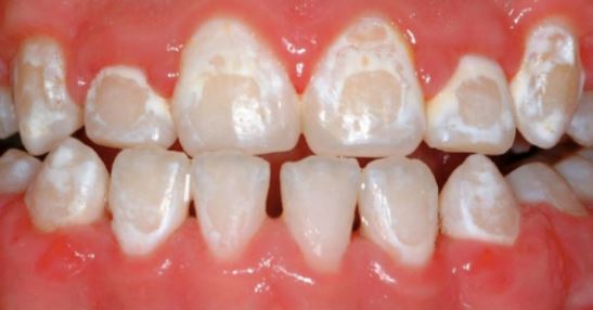 yellow or white stains on teeth after braces
