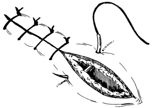 Suturing Techniques in Dentistry