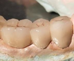 Classification of Fixed Partial Dentures