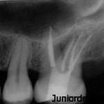 Root canal treatment restoration