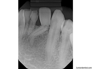 Dilacerated tooth with curved roots radiograph