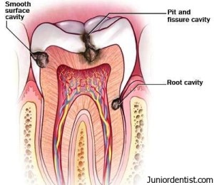 Micro organisms responsible for caries