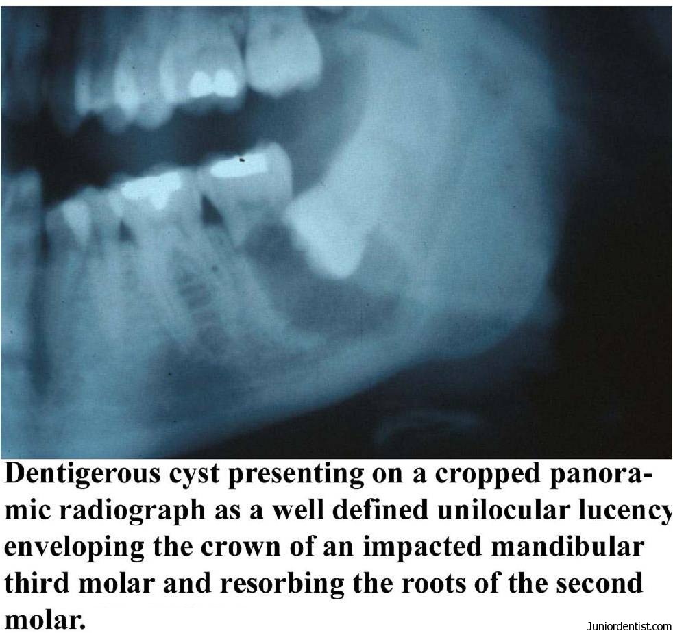 Dentigerous Cyst Definition Clinical Features Types Radiographic