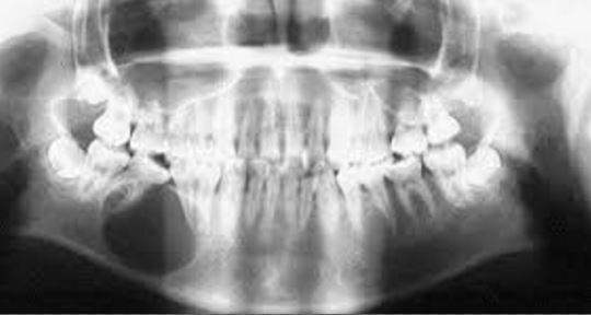 syndromes related to odontogenic tumors of the oral cavity