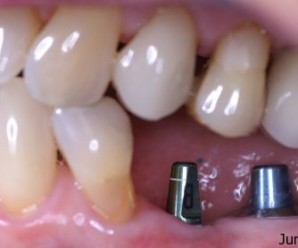 Useful Tips for dental implants care