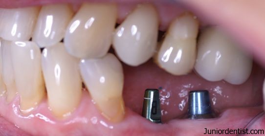 Useful Tips for dental implants care