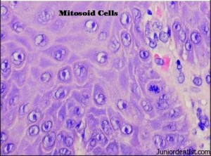 Focal Epithelial hyperplasia -Mitosoid cells