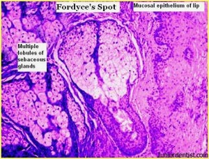 Fordyce spots or granules - Histology