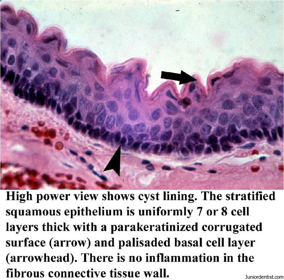 Primordial Cyst histology