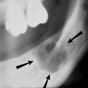 Primordial Cyst in 3rd molar region