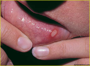 Minor Apthous Ulcer